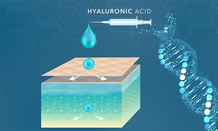 Axit hyaluronic