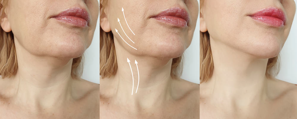 Chuyên gia da liễu tư vấn: Căng da mặt bằng chỉ hiệu quả như thế nào?