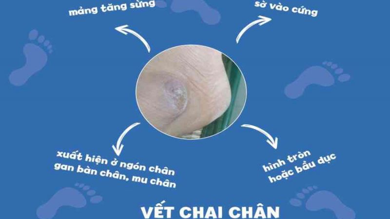 9 cách chữa chai chân đơn giản và nhanh nhất