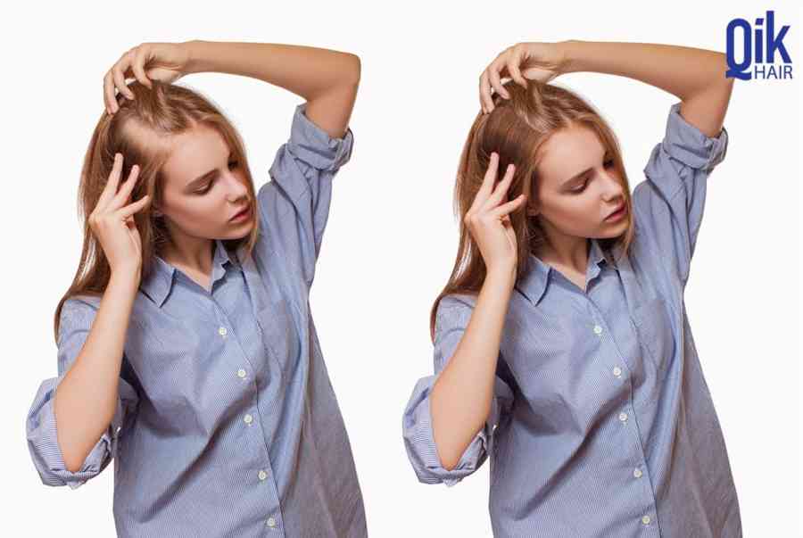 “Bật mí” 10 cách trị hói tóc ở nữ giới đơn giản và nguyên nhân