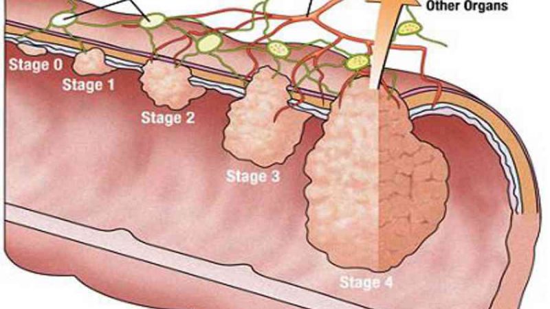 Ung thư đại tràng di căn sống được bao lâu?