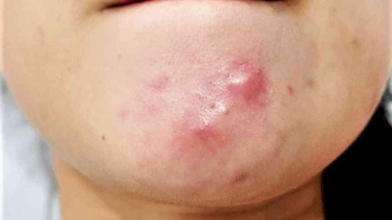 Mụn ở cằm: Nguyên nhân và cách điều trị hiệu quả – YouMed