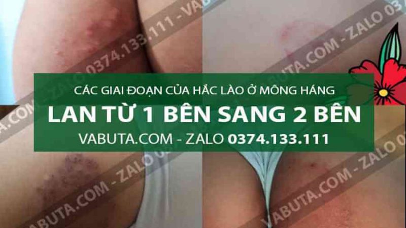 8+ Cách chữa hắc lào ở Háng Và Mông bằng dân gian an toàn tại nhà