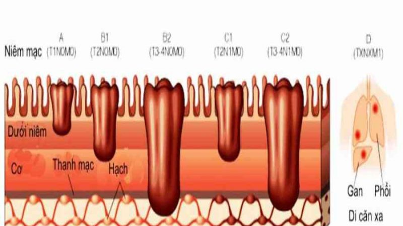 Tài liệu ung thư đại trực tràng – Bệnh viện ung bướu nghệ an