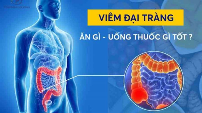 Viêm đại tràng nên ăn gì, uống thuốc gì tốt nhất theo chuyên gia