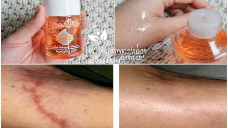 Tinh dầu Bio-Oil 60ml của Úc – Kem chống trị rạn da, làm mờ sẹo