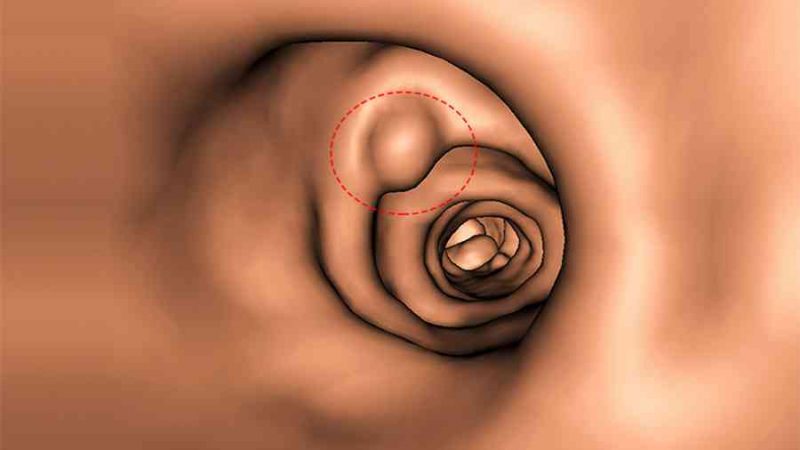 Polyp là gì? 4 bộ phận trong cơ thể nếu có polyp thì nguy cơ mắc bệnh ung thư là rất cao