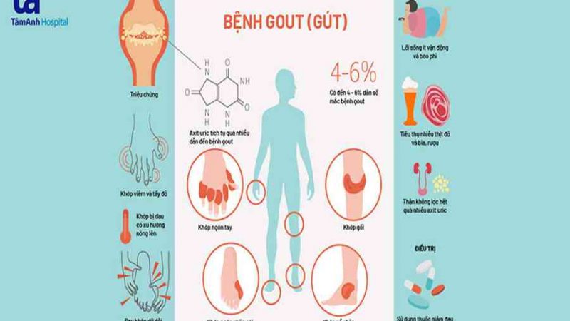 Bệnh Gout (Gút): Nguyên nhân, triệu chứng, chẩn đoán, phòng ngừa