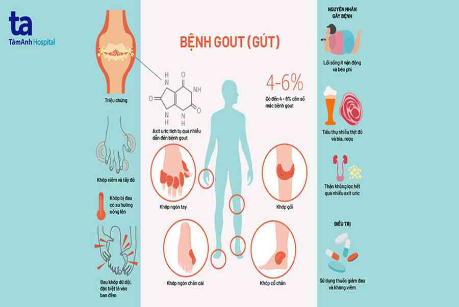 Bệnh Gout (Gút): Nguyên nhân, triệu chứng, chẩn đoán, phòng ngừa