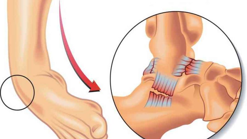 Trật mắt cá chân: Tôi nên làm như thế nào? – YouMed