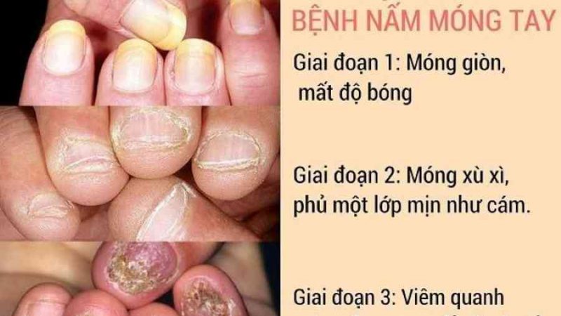 Nấm móng tay có thuốc bôi gì để trị?