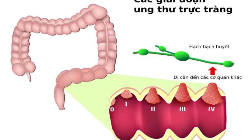 Dấu hiệu ung thư trực tràng là gì? Có nguy hiểm không? • Hello Bacsi