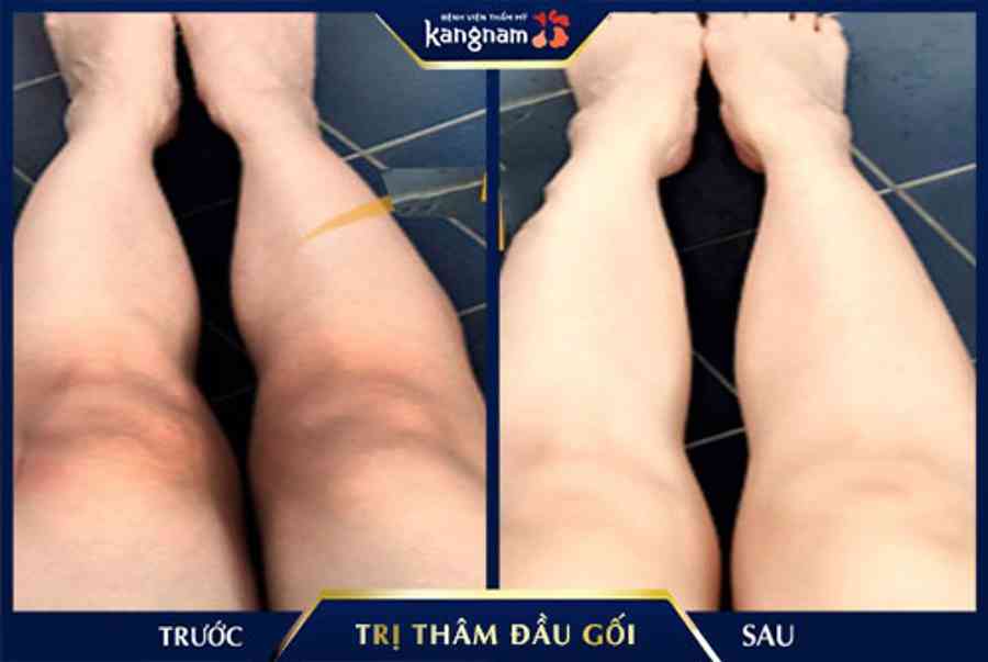 10+ Cách trị thâm Đầu gối, Khuỷu tay hiệu quả nhanh tại nhà