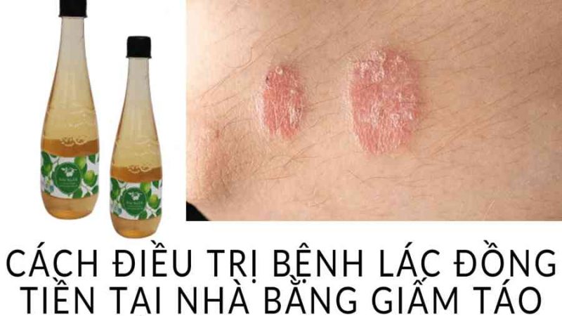 Trị Lác Đồng Tiền | Tổng hợp 17+ cách trị lác, hắc lào tại nhà nhanh nhất