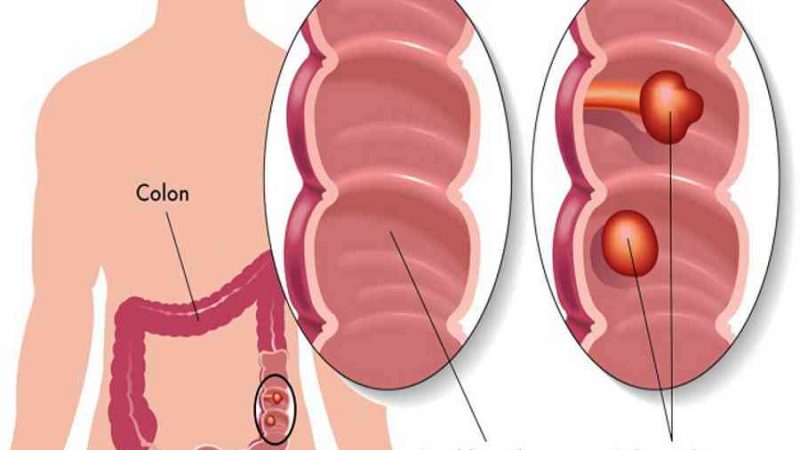 Đau đại tràng đau ở đâu? Cảnh báo những bệnh nguy hiểm nào?