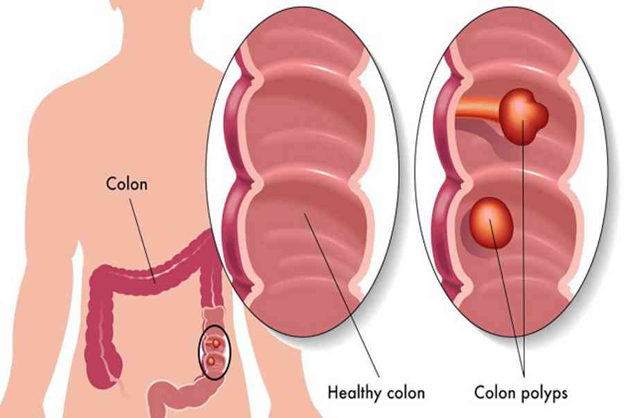 Đau đại tràng đau ở đâu? Cảnh báo những bệnh nguy hiểm nào?