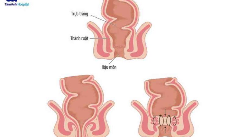 Bệnh sa trực tràng: Hình ảnh, dấu hiệu và cách điều trị | Tâm Anh