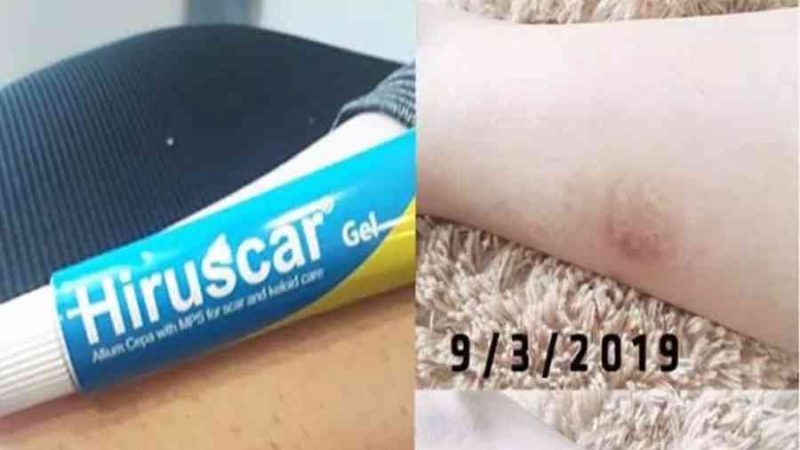 Review gel trị sẹo Hiruscar: Kẻ thù của những vết sẹo cứng đầu! – BlogAnChoi