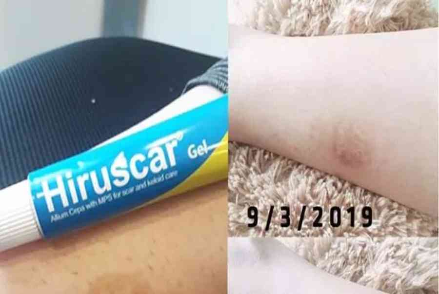 Review gel trị sẹo Hiruscar: Kẻ thù của những vết sẹo cứng đầu! – BlogAnChoi