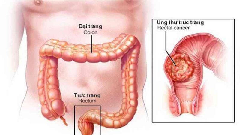 K trực tràng thấp là gì? Nguyên nhân, triệu chứng và điều trị