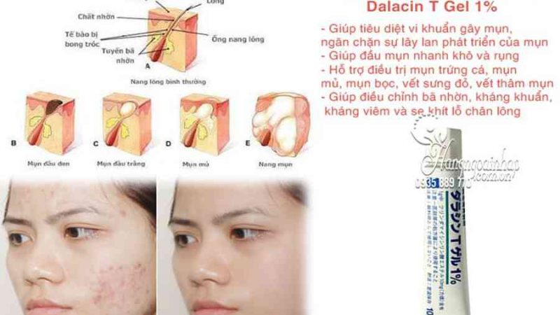 Kem trị mụn Dalacin T Gel 1% của Nhật trị mụn bọc hiệu quả