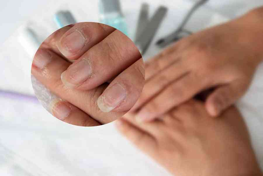 Móng tay bị rỗ là bệnh gì? Điều trị như thế nào hiệu quả?
