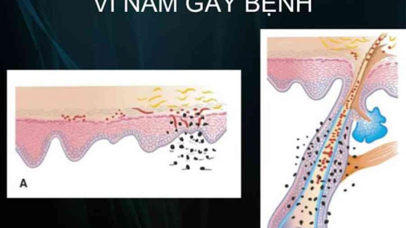 Bệnh hắc lào là gì? 3 Cách chữa bệnh hắc lào tận gốc hiệu quả – Khai báo y tế