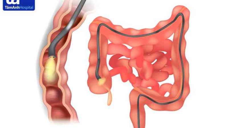 Nội soi đại tràng: Quy trình, chi phí, nội soi có đau không