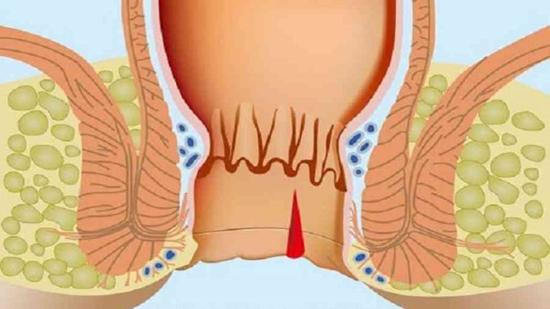 Nứt kẽ hậu môn tự lành được không? Giải pháp điều trị?