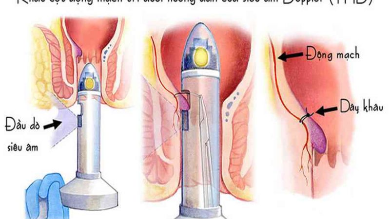 Phẫu thuật cắt trĩ: 7 phương pháp phổ biến nhất năm 2021