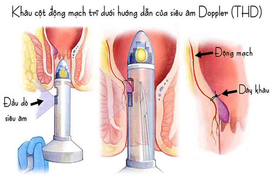 Phẫu thuật cắt trĩ: 7 phương pháp phổ biến nhất năm 2021