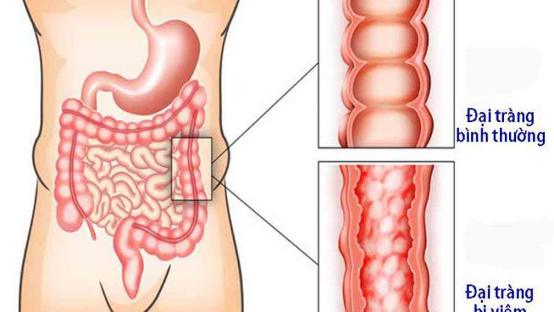 Viêm đại tràng co thắt mạn tính