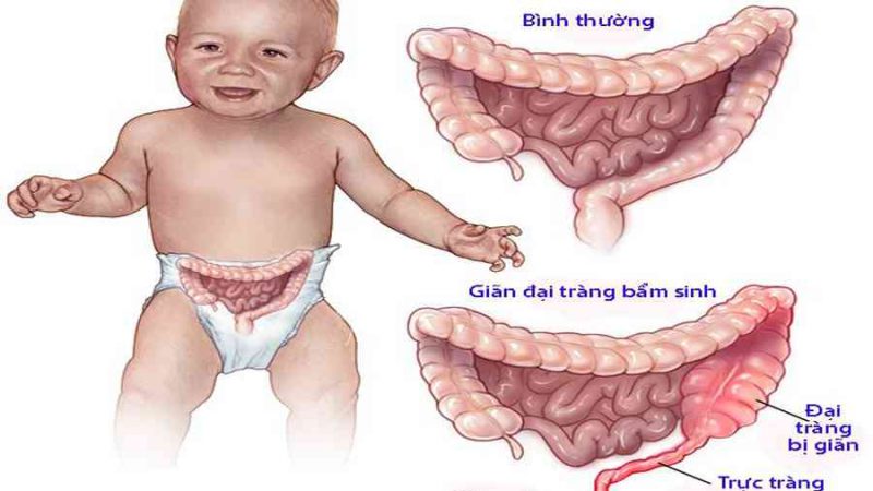 Giãn đại tràng bẩm sinh