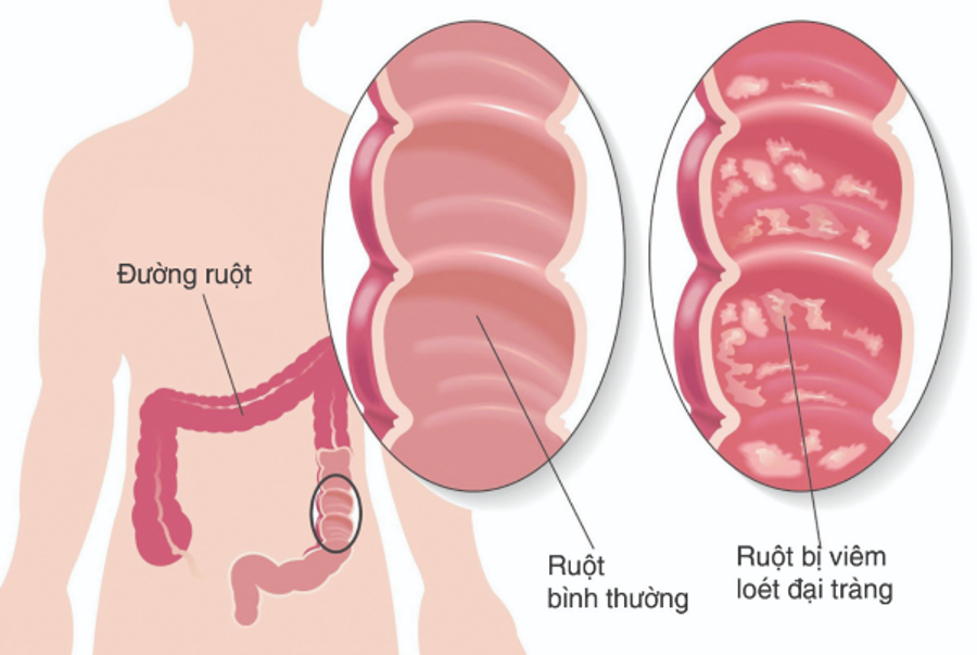 5 bài thuốc nam điều trị viêm đại tràng mạn tính