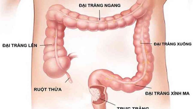 Polyp đại tràng sigma: căn bệnh không phải ai cũng biết