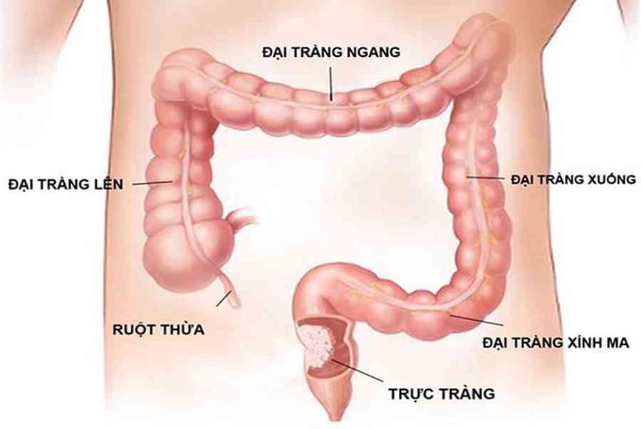 Polyp đại tràng sigma: căn bệnh không phải ai cũng biết