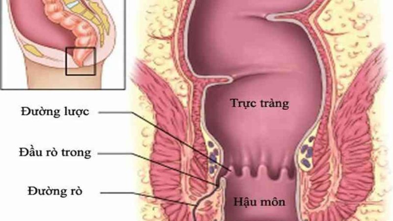 Rò hậu môn: Tác hại khôn lường và giải pháp “vàng” chữa trị