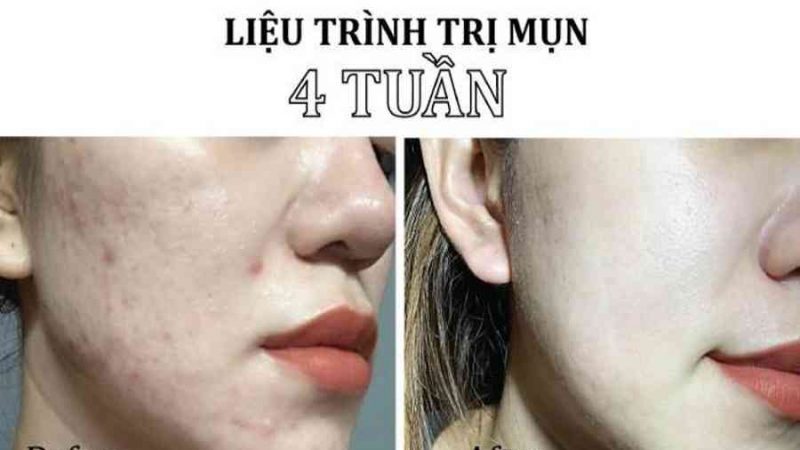 Review chân thật top 8 spa nặn mụn uy tín HCM giá chỉ từ 150k xịn xò