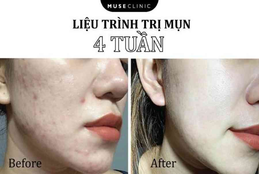 Review chân thật top 8 spa nặn mụn uy tín HCM giá chỉ từ 150k xịn xò