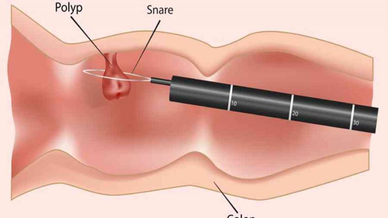 Tầm soát ung thư đại tràng – Bệnh Viện Ung Bướu Đà Nẵng