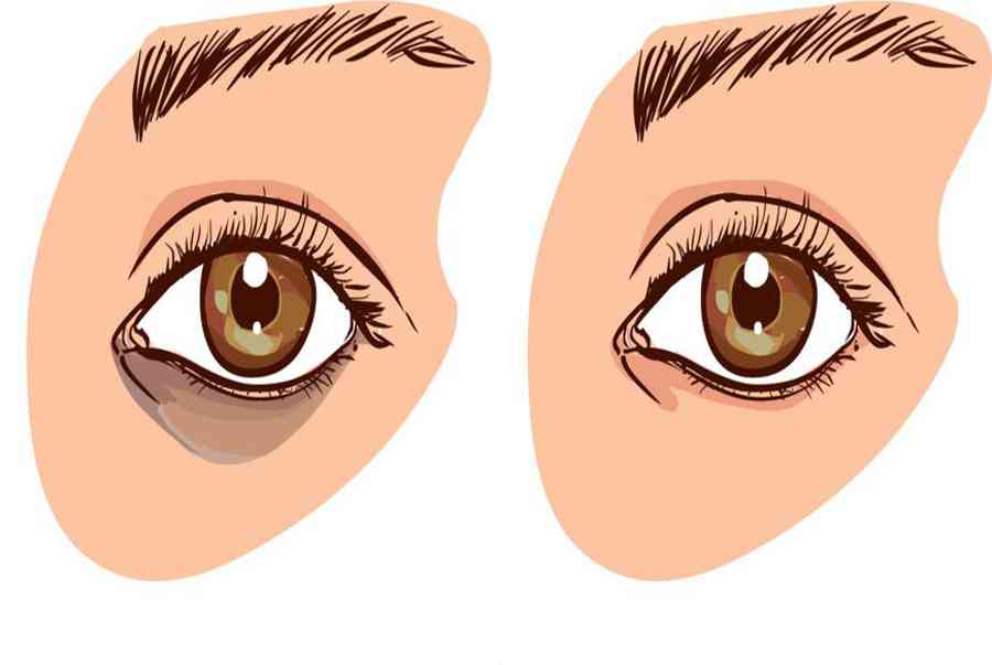 7 cách trị quầng thâm mắt đơn giản và hiệu quả tại nhà