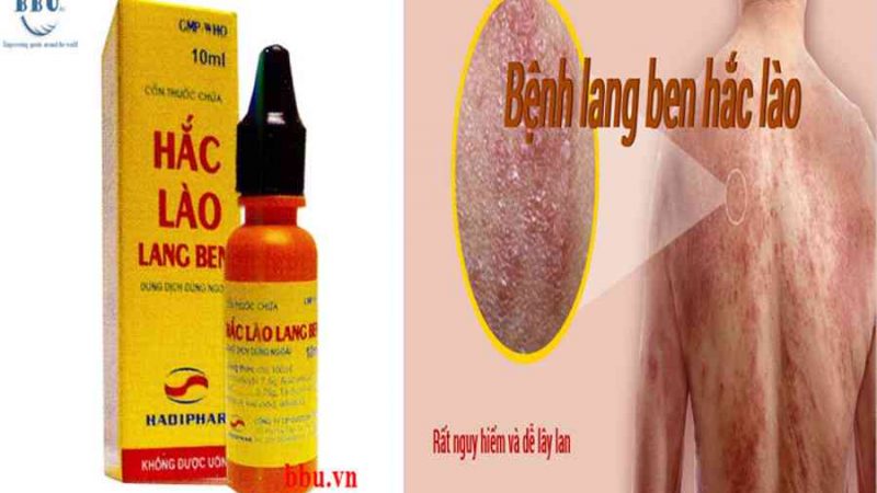 Thuốc hắc lào lang ben 10ml