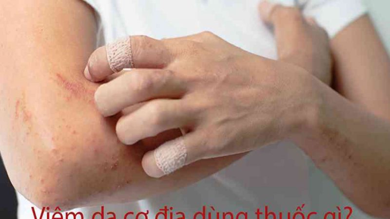 Các Loại Thuốc Đặc Trị Viêm Da Cơ Địa (Kem Bôi + Uống) Hiệu Quả Nhất