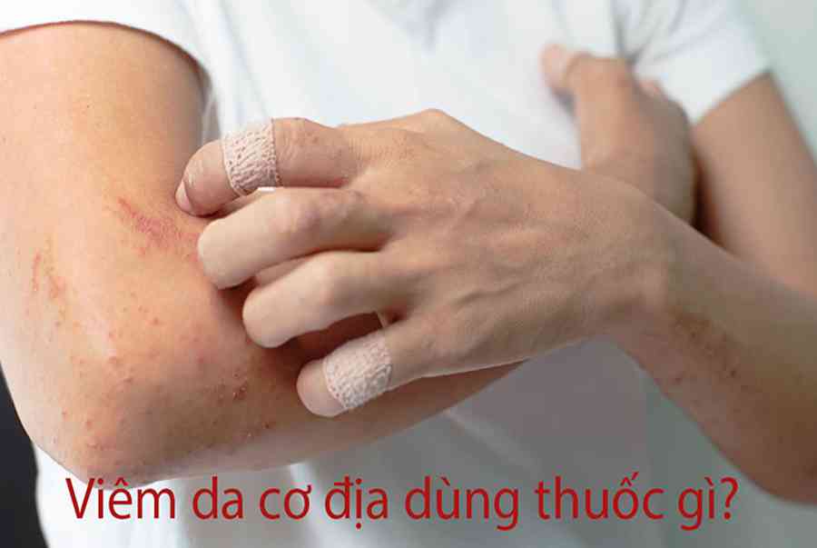 Các Loại Thuốc Đặc Trị Viêm Da Cơ Địa (Kem Bôi + Uống) Hiệu Quả Nhất