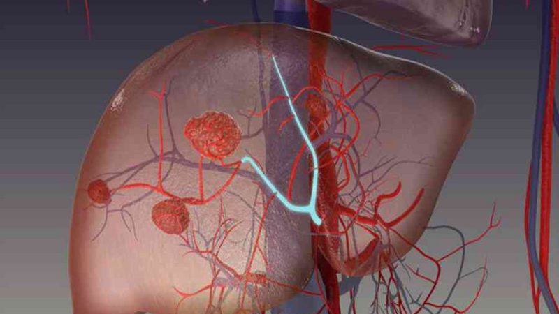 Bệnh hemangioma gan là gì, nguyên nhân gây bệnh và cách điều trị