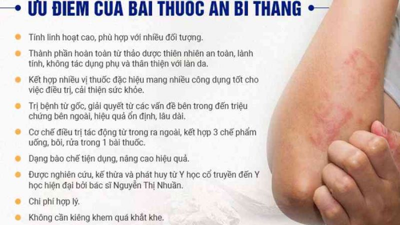 10 Cách Chữa Dị Ứng Da Tại Nhà Nhanh Khỏi, Dễ Làm