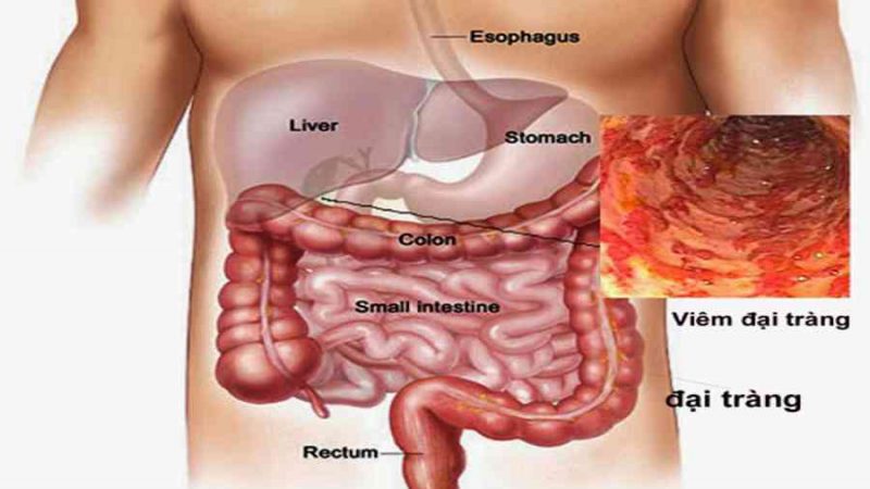 Đau bụng do viêm đại tràng ở vị trí nào?