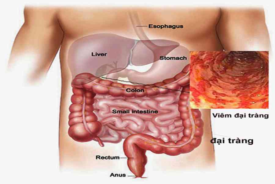 Đau bụng do viêm đại tràng ở vị trí nào?