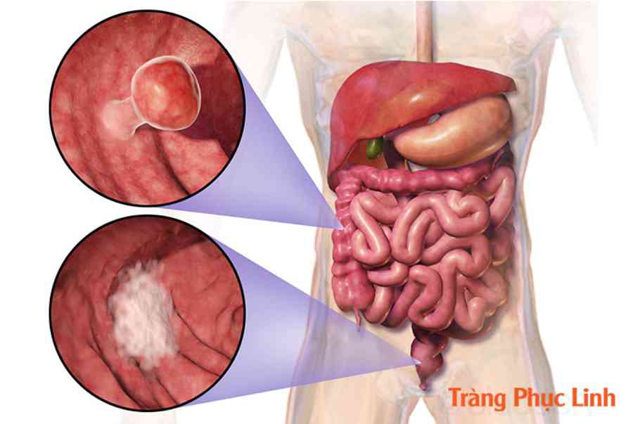 Viêm đại tràng lên: Nguyên nhân, triệu chứng, cách điều trị