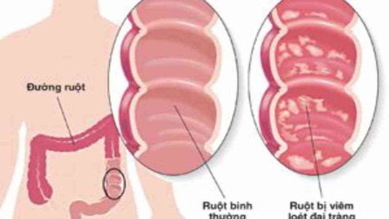 Viêm loét đại tràng: Hiểu đúng để chữa khỏi – YouMed